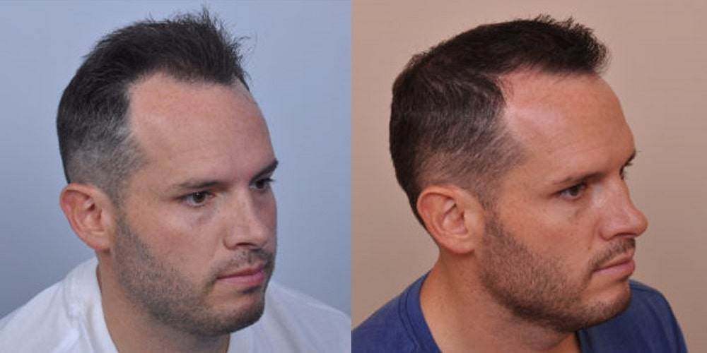 Hair Transplant USA | TOP 10 Clinics in 2023