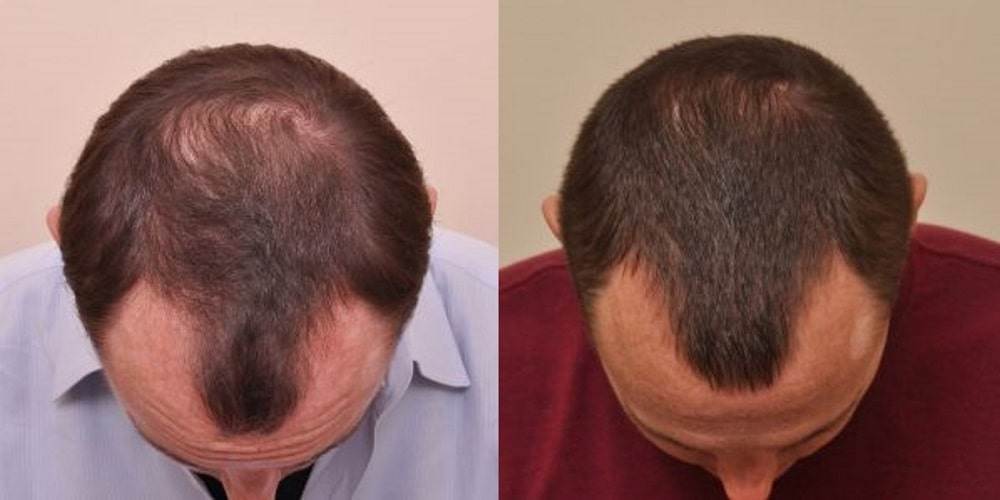 Anderson Center for Hair is the leading hair restoration practice in Georgia