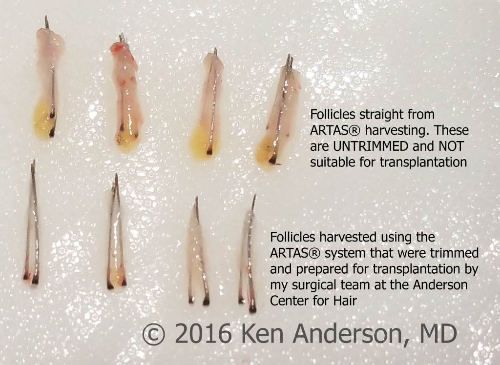 Patient had an ARTAS hair transplant procedure by Dr. Ken Anderson at the Anderson Center for Hair; Hair transplant; hair restoration; hair loss; ARTAS; NeoGraft; stem cells; PRP; ACell; Anderson; hairishot; regrow; ISHRS; balding; atlantahairsurgeon; IAHRS; baldtruthtalk; hair; hairloss; FUE; follicular unit excision; best