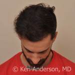 Patient had an ARTAS hair transplant procedure by Dr. Ken Anderson at the Anderson Center for Hair; Hair transplant; hair restoration; hair loss; ARTAS; NeoGraft; stem cells; PRP; ACell; Anderson; hairishot; regrow; ISHRS; balding; atlantahairsurgeon; IAHRS; baldtruthtalk; hair; hairloss; FUE; follicular unit excision; best