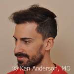 Anderson Center for Hair ARTAS hair transplant restoration ARTAS