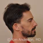 Patient had an ARTAS hair transplant procedure by Dr. Ken Anderson at the Anderson Center for Hair FUE ARTAS hair restoration PRP