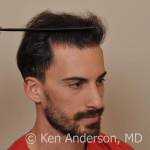Anderson Center for Hair ARTAS hair transplant restoration