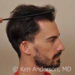 Anderson Center for Hair ARTAS hair transplant restoration