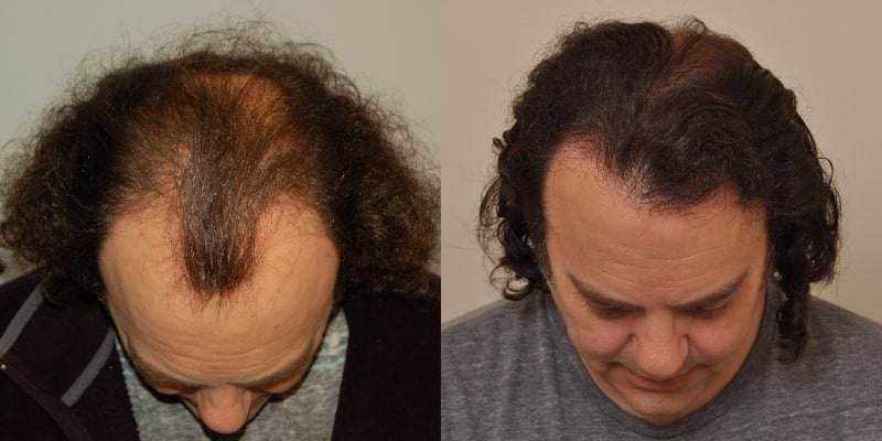Anderson Center for Hair is the leading hair restoration practice and hair surgery center in Atlanta