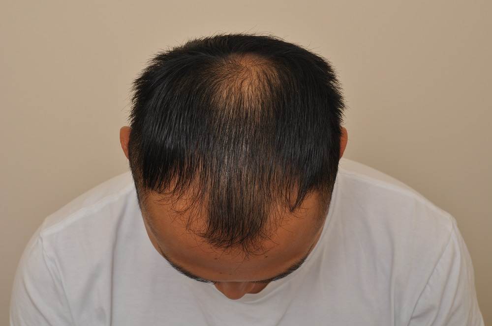 Anderson Center for Hair in Atlanta and Alpharetta PRP Patient After