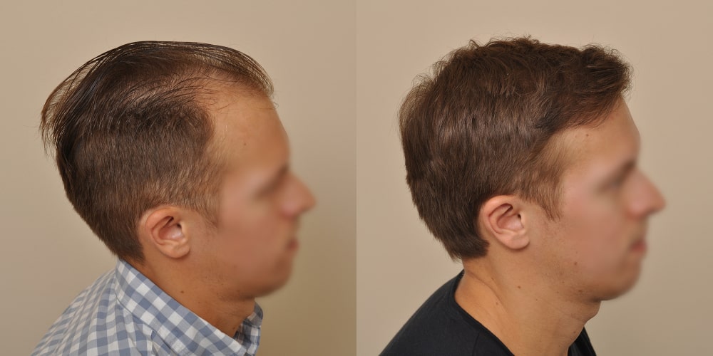 Anderson Center for Hair is the leading hair restoration practice and hair surgery center in Atlanta