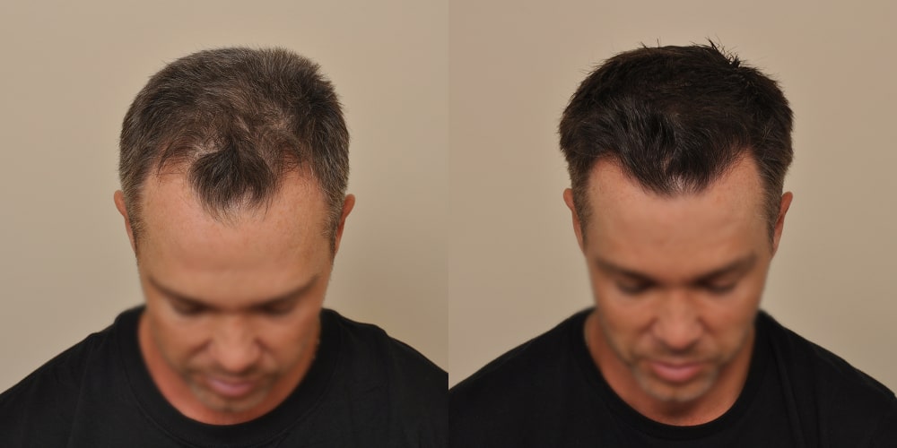 Anderson Center for Hair Before-and-After Photos Norwood Scale 2a