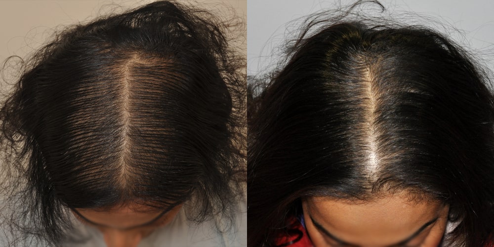 Anderson Center for Hair Before-and-After Photos Non-Surgical