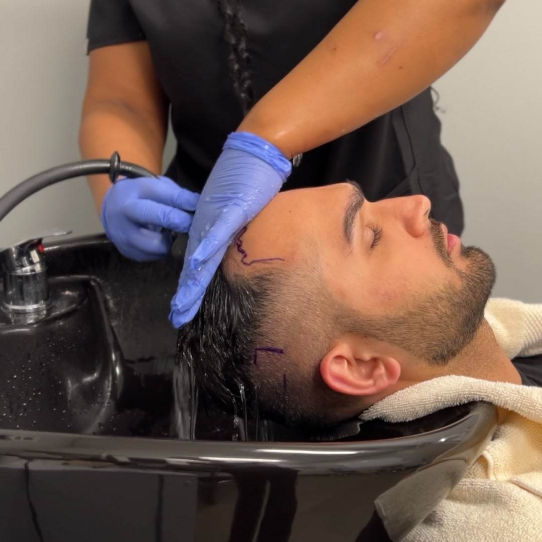 Chail's hair restoration journey with Dr. Jeremy Wetzel at Anderson Center for Hair in Atlanta