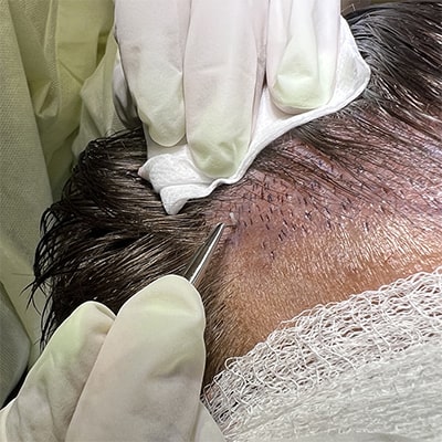 17 Tim Welbaum's hair transplant journey at Atlanta Center for Hair in Atlanta