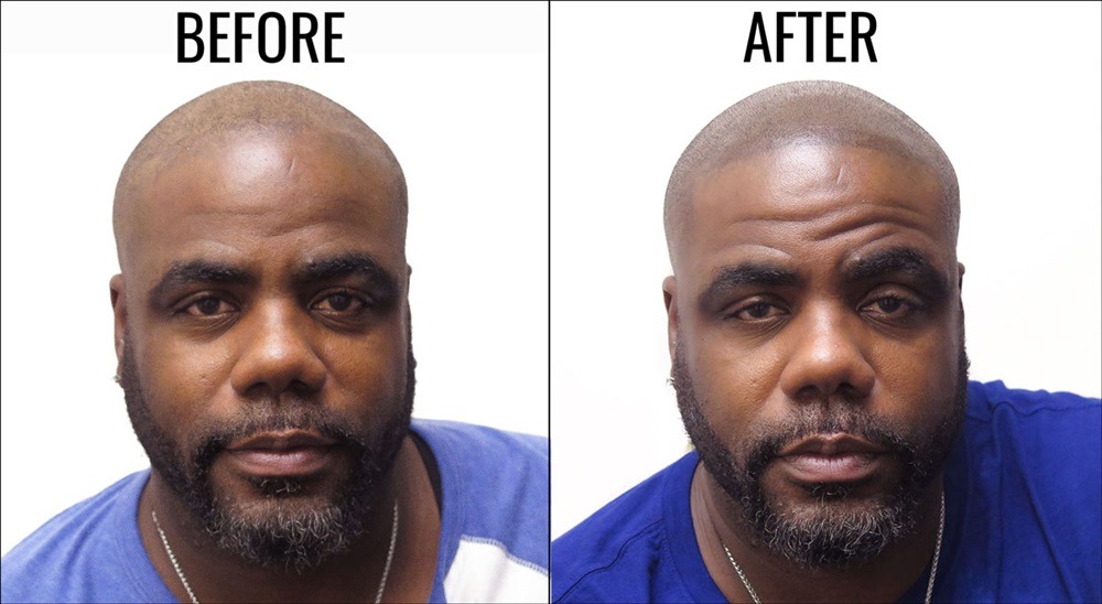 2 Anderson Center for Hair in Atlanta offers scalp micropigmentation that is ideal for thinning hair balding and scar concealment