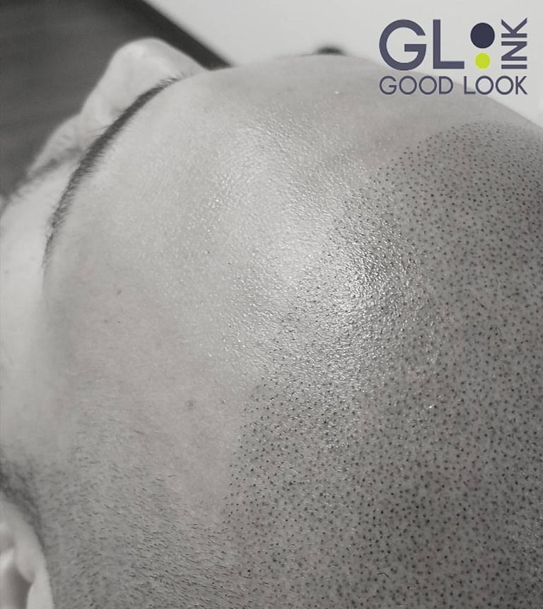 3 Anderson Center for Hair in Atlanta offers scalp micropigmentation that is ideal for thinning hair balding and scar concealment