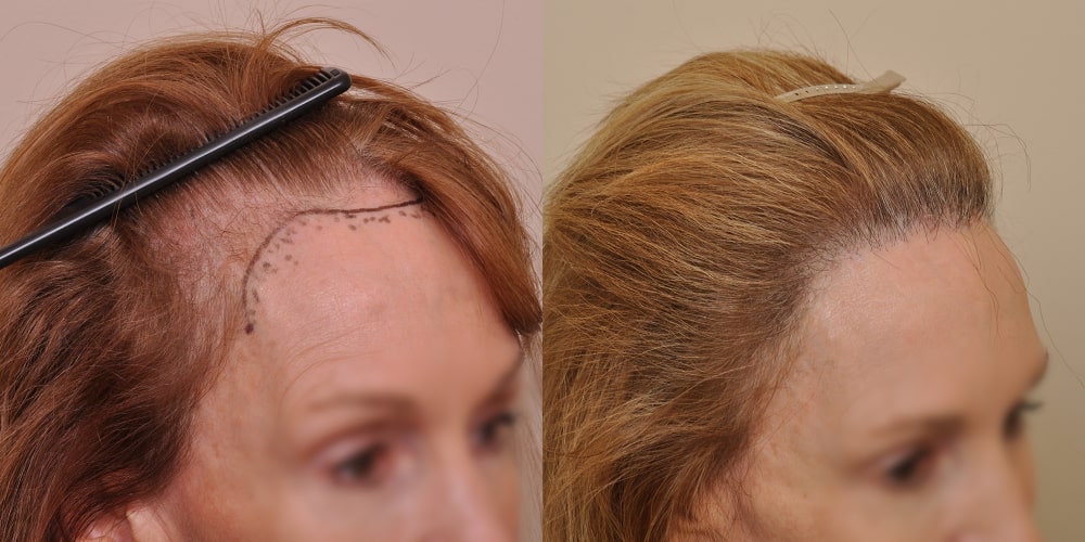 Turn to Anderson Center for Hair in Atlanta for hair transplant information and hair loss basics