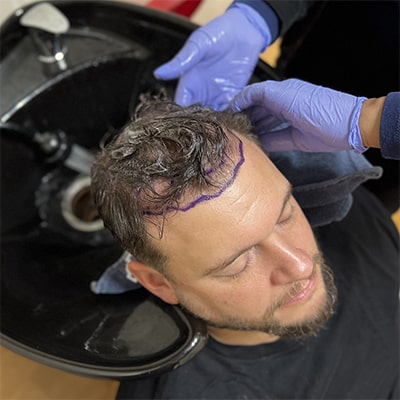 9 Tim Welbaum's hair transplant journey at Atlanta Center for Hair in Atlanta