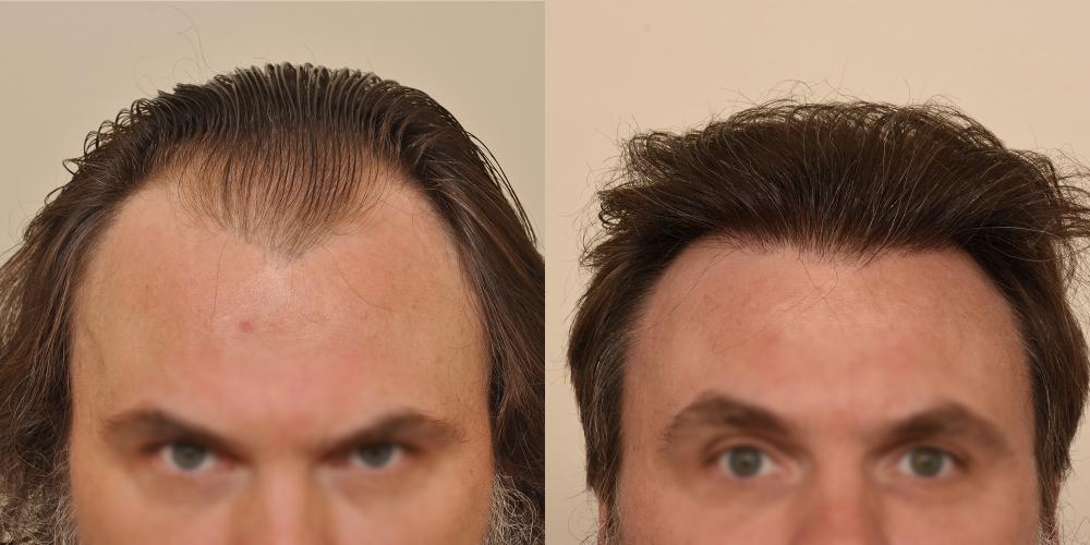 Turn to Anderson Center for Hair in Atlanta for hair loss basics and hair transplant info