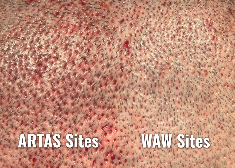 Close-up comparison of hair transplant extraction sites using two different devices: ARTAS on the left and WAW on the right. The ARTAS extraction sites are larger and more inflamed, while the WAW extraction sites show less redness and appear much smaller. The image highlights the significant difference in extraction site appearance between the two devices.