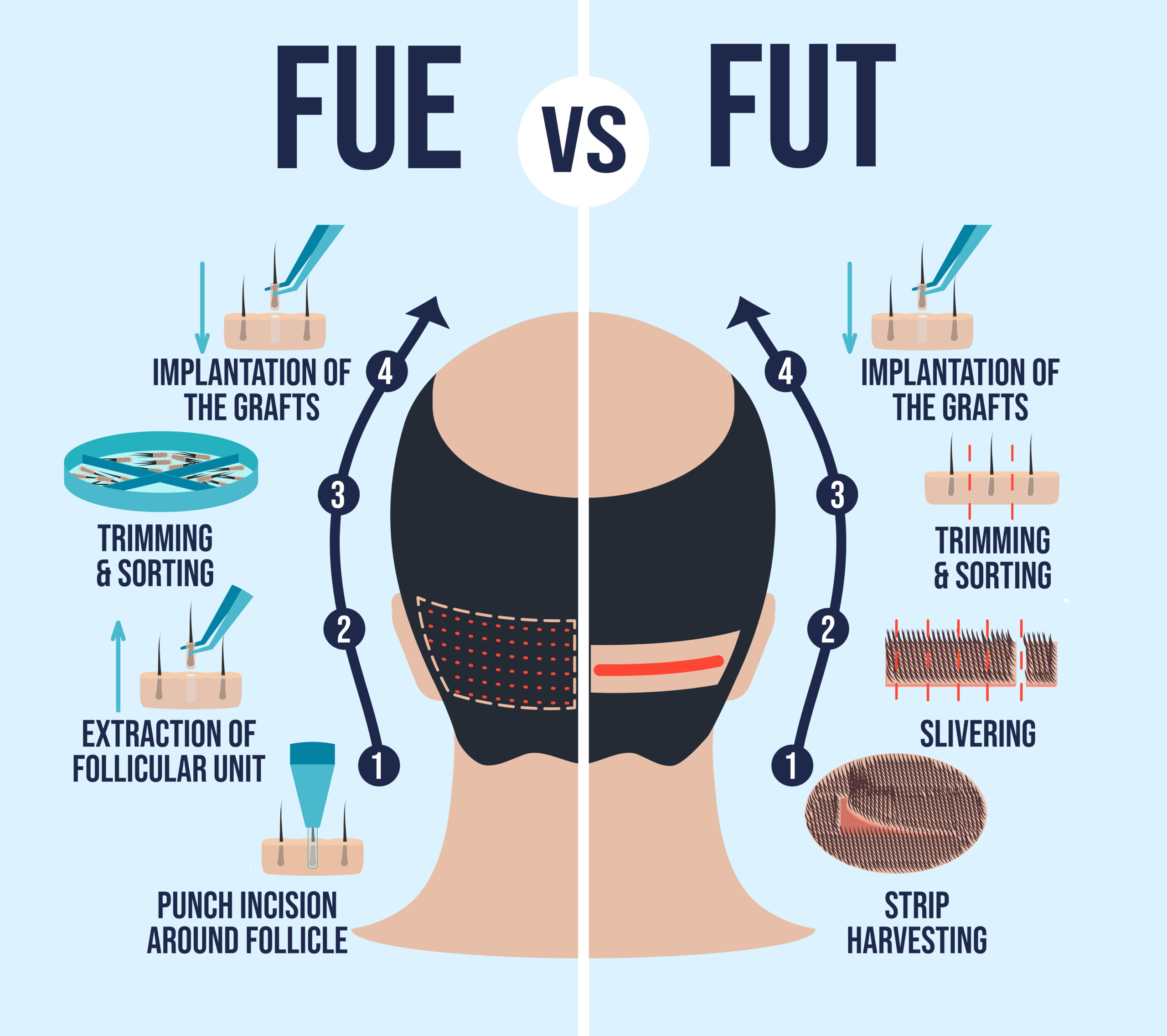 Diagram showcasing the similarities and differences between FUE and FUT hair transplants.